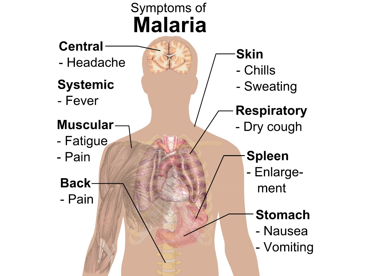 Malaria Symptoms | MalariaResurgence | MalariaOutbreak | PublicHealthAlert | Texas | Florida |